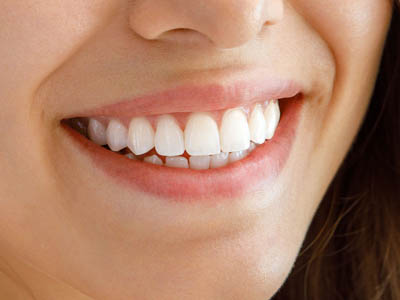 Clareamento Dental