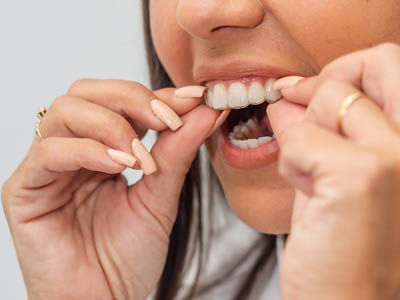 Invisalign