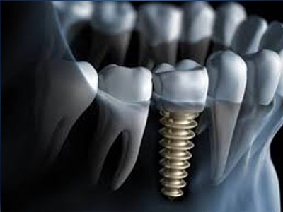 Implante Dentário